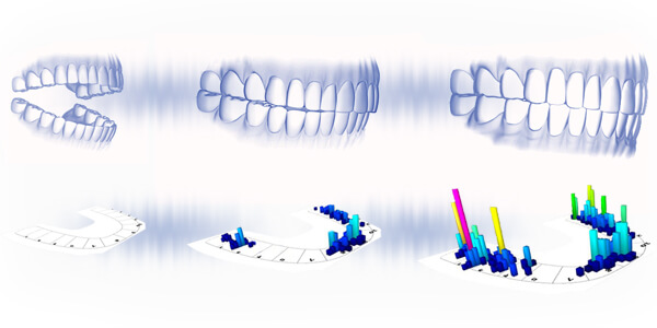Analisi Progressiva dell'occlusione dentale