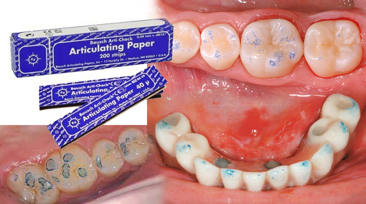 Cartine articolari e marcatura dei denti, per verificare l'occlusione dentale
